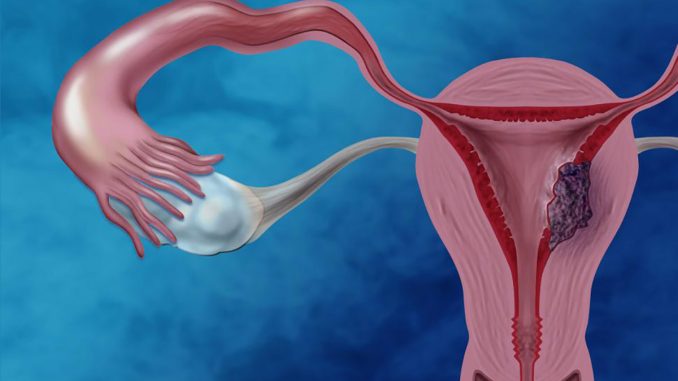EndometrialCancerIllustration