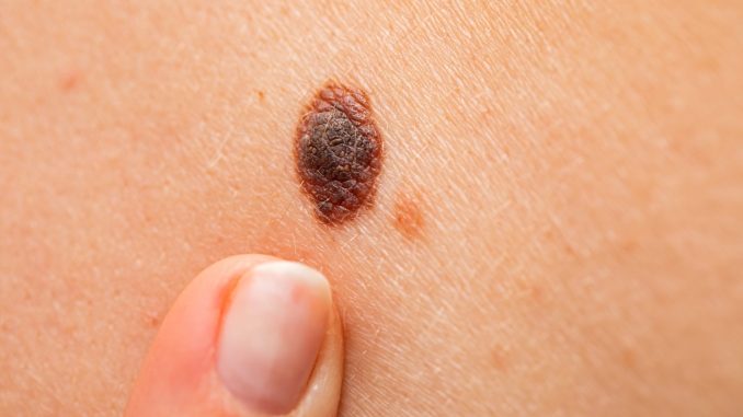 Melanoma