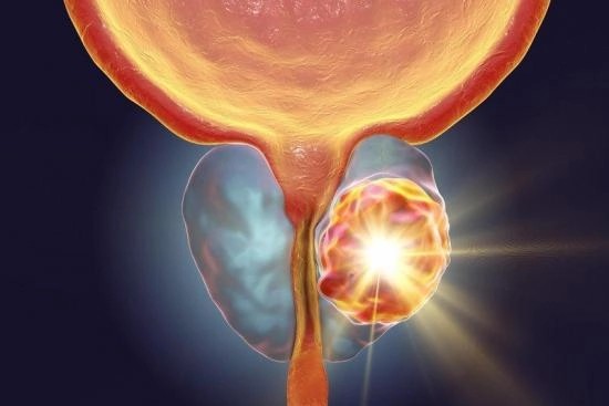 Prostate Cancer-1