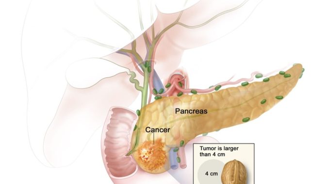 pancreatic cancer-1