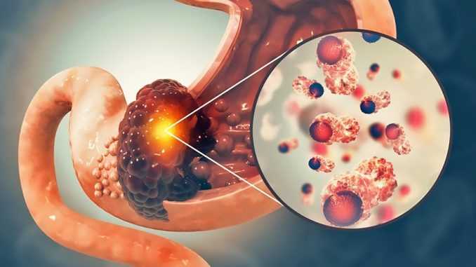Gastric Cancer