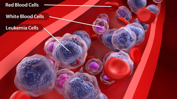 Acute-Myeloid-Leukemia-2