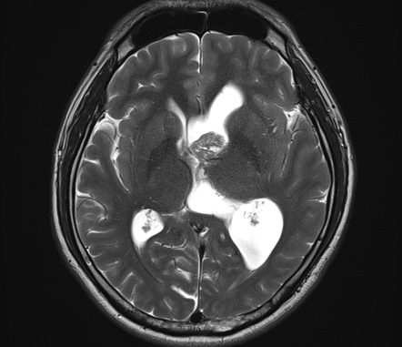 Ependymoma