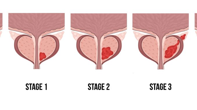 Prostate-Cancer-2