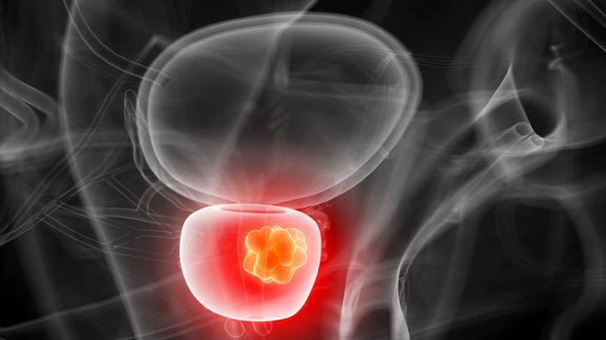 Prostate-Cancer