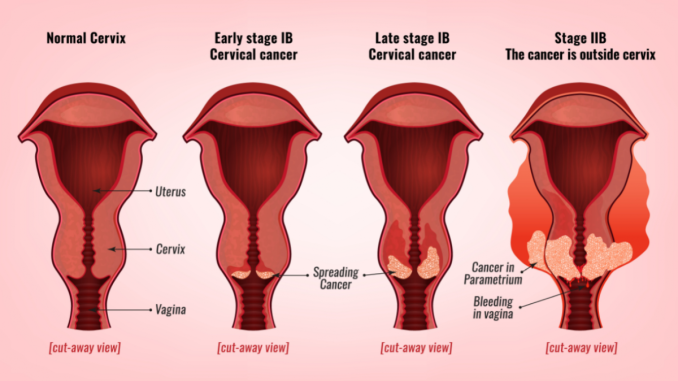 cervical-cancer-Staging