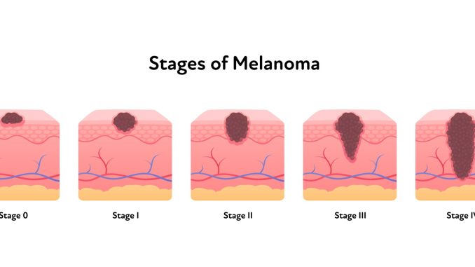 melanoma-Staging