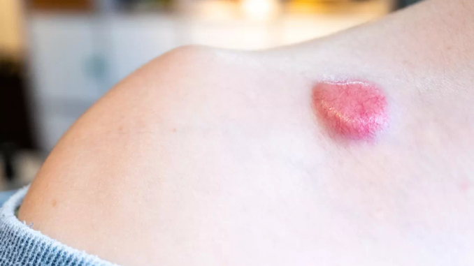 non-melanoma-Skin-Cancer-2