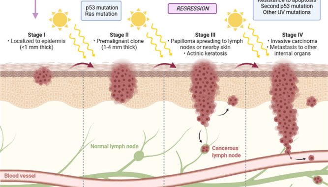 non-melanoma-Skin-Cancer-Staging