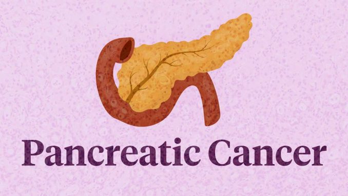 pancreatic-cancer-4